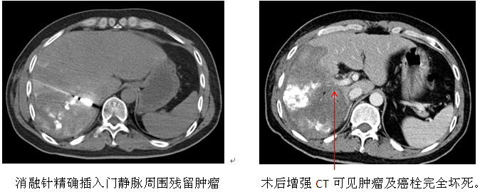 肿瘤3.png