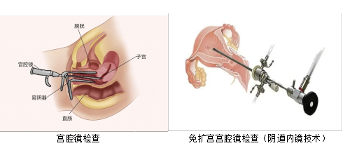 阴道内镜技术.png