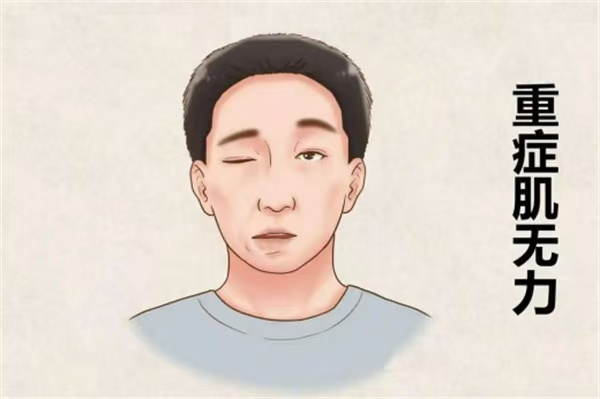 重症肌无力.png